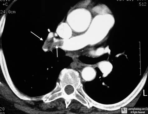 Learning Radiology - pulmonary, embolism, embolus, thromboembolism, pe