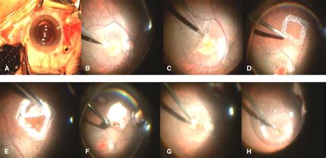 Autologous Transplantation of the Retinal Pigment Epithelium and Choroid in the Treatment of Age ...