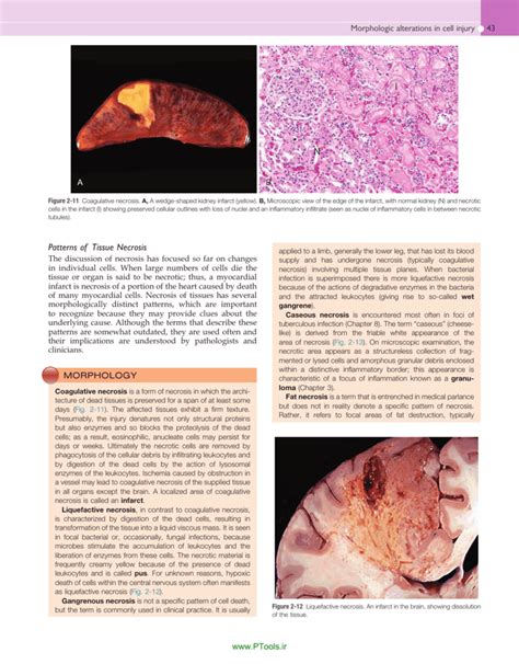 Patterns of Tissue Necrosis