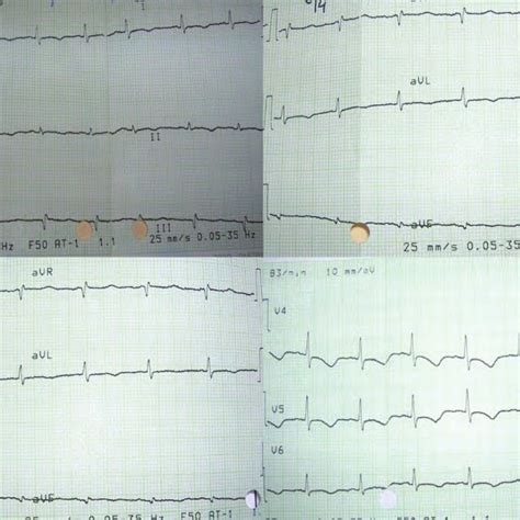 ECG showing congenital heart block | Download Scientific Diagram