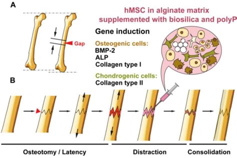 Distraction osteogenesis scheme. (A) The healthy part of the bone is... | Download Scientific ...