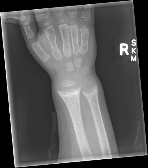 Rickets Disease X Rays