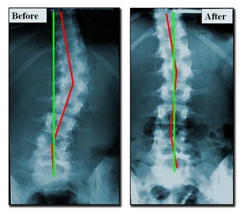 Scoliosis Correction