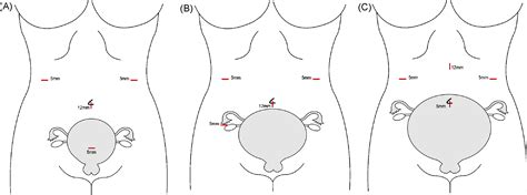 Laparoscopic appendectomy performed during pregnancy by gynecological ...