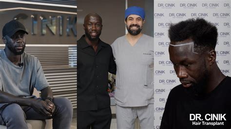 Arsenal Legend Bacary Sagna Reborn with Dr. Cinik's Hair Transplant