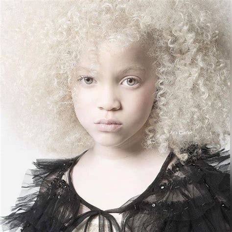 Pin by D on Kids Corner | Albinism, African american girl, Stunning eyes