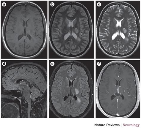 Standardized brain MRI protocol to evaluate patients in whom multiple... | Download Scientific ...