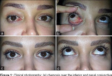 Figure 1 from Treatment of Persistent Chemosis after Upper Lid Blepharoplasty by Hand-Held Fine ...