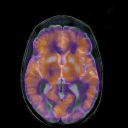 Hypertensive Encephalopathy; Encephalopathy, Hypertensive