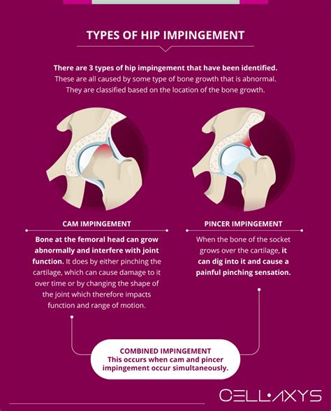 Can Regenerative Medicine Reduce Hip Impingement Surgery Recovery Time? - Cellaxys