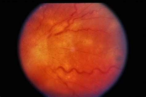 DUSN / Optic Papillitis - Retina Image Bank