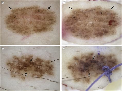 Ex Vivo Dermoscopy of Melanocytic Tumors: Time for Dermatopathologists to Learn Dermoscopy ...