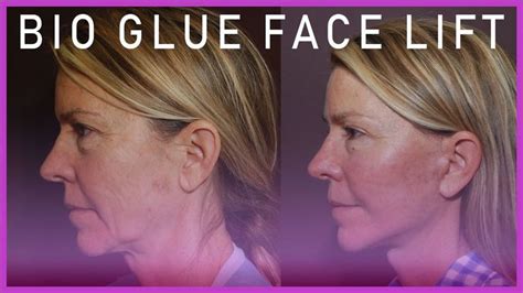 Biological Glue Face Lift | Facelift, Neck lift, Rhinoplasty