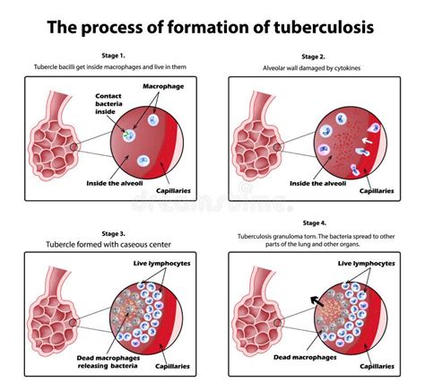 The Process of Tuberculosis Formation. Infographics. Vector Illustration on Isolated Background ...