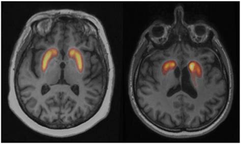 Frontiers | The Story of the Dopamine Transporter PET Tracer LBT-999: From Conception to ...