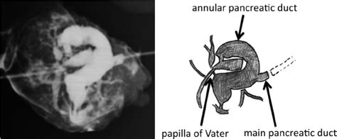 Extirpated annular pancreas. Finally the annular pancreas head was... | Download Scientific Diagram