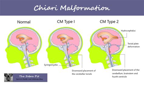 Icd 10 Code For Chiari Malformation Type I