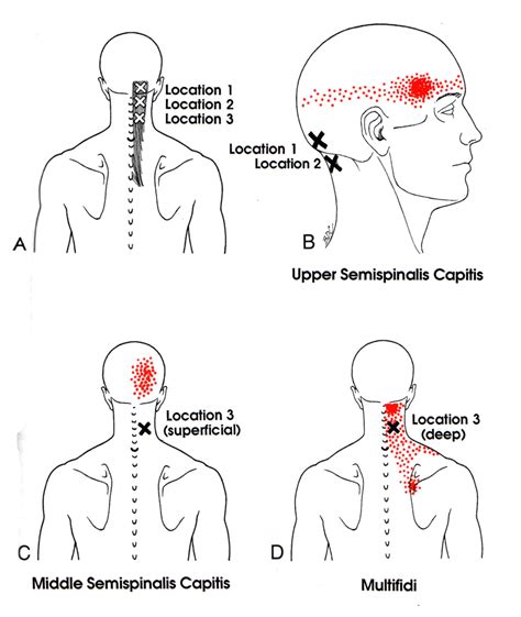 Semispinalis Capitis | The Trigger Point & Referred Pain Guide