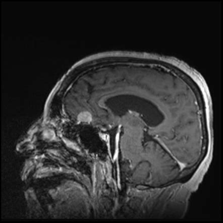 Olfactory groove meningioma | Radiology Case | Radiopaedia.org