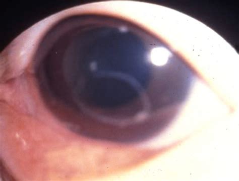 Angiostrongylus cantonensis in the anterior chamber of | Open-i