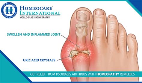 For best Psoriasis Arthritis treatment approach Homeocare International