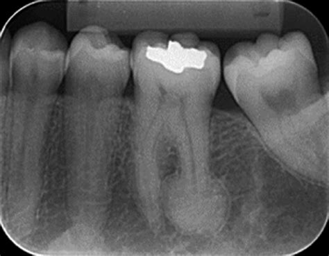 Periapical radiograph showing radiopaque halo around the root of tooth ...