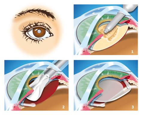 Cataract surgery detached retina symptoms - rodenmixer