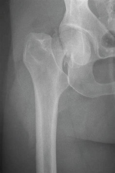 AP radiograph of the right hip demonstrating a subcapital femoral neck ...