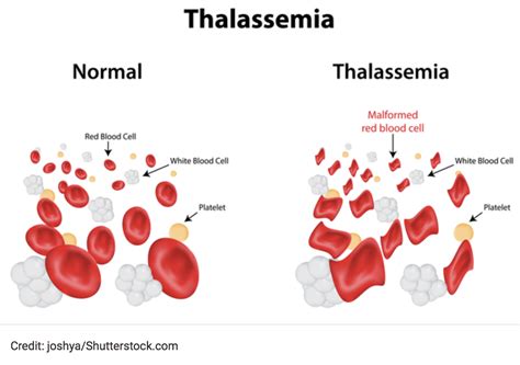 Beta-Thalassemia | CheckRare