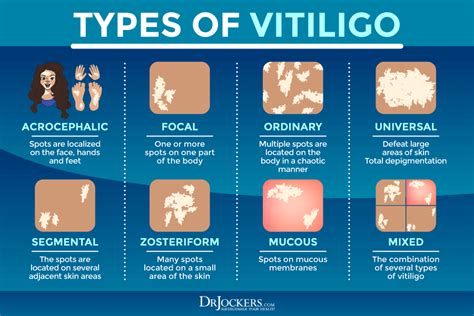 Vitiligo: Symptoms, Causes, and Support Strategies - DrJockers.com