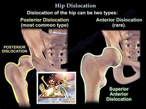 Hip Dislocation Exercises - Fitness | NoahStrength.com