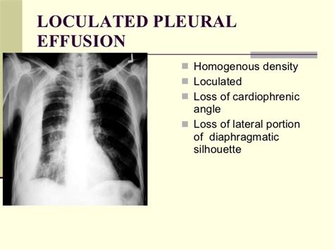 Loculated Pleural Effusion / Loculated Pleural Effusion Images, Stock ...