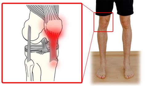 Patellar Tendonitis Symptoms: 3 Red Flags You Need to Know