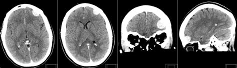 Radiology MRI: Incidental Meningioma