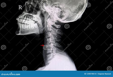 Fractured cervical spine stock photo. Image of nerve - 129019814