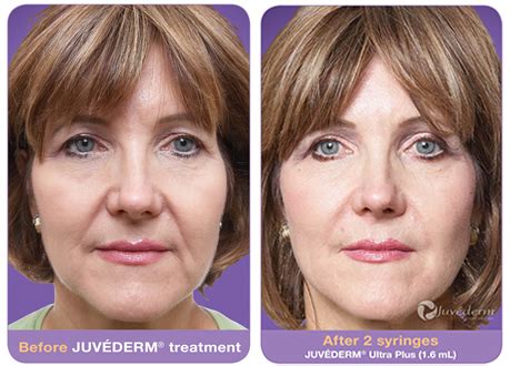 Juvederm XC | Treatment FAQ, Cost, Before & After | Hartford CTJuvederm XC | Treatment FAQ, Cost ...