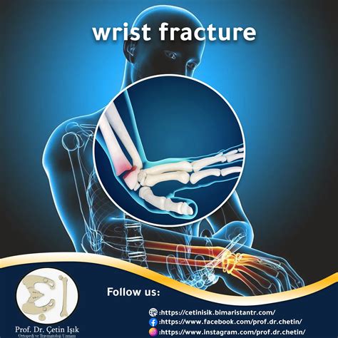 Fracture of the hand joint, how to diagnose it and treat it - Dr. What's wrong with you?