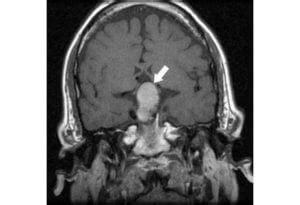 Pituitary Tumor (adenoma) | Wills Eye Hospital