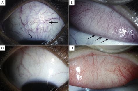 Superior limbic keratoconjunctivitis causing chronic ocular irritation in a child - Journal of ...