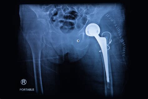 Couple Files Stryker Hip Replacement Lawsuit