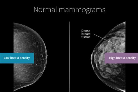 mammogram_breast_density - Wellend Health