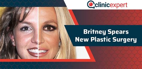 Britney Spears New Plastic Surgery | ClinicExpert International Healthcare