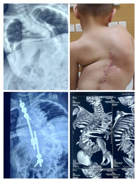 Congenital Kyphoscoliosis - Detethering followed by Growth Rod Distraction This 6 year old boy ...