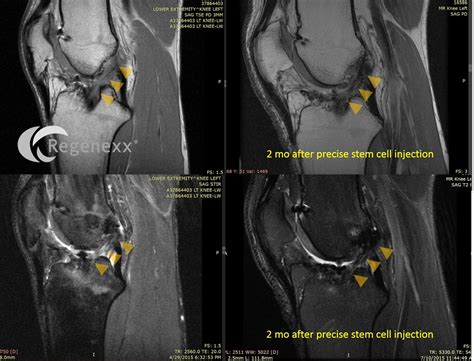 ACL Surgery Failure: Can You Heal a Torn ACL Graft with Stem Cells ...