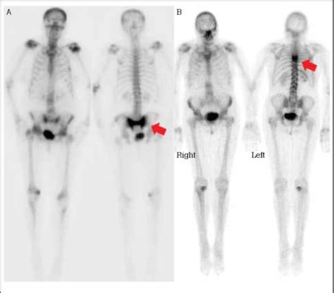 Figure 4 from Bone scans. | Semantic Scholar