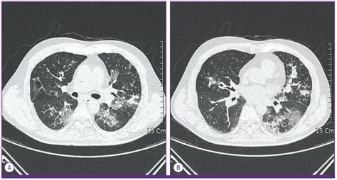 Chest CT of the patient on hospital day 13 shows numerous small... | Download Scientific Diagram