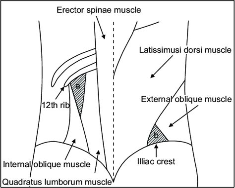 Lumbar Triangle Hernia