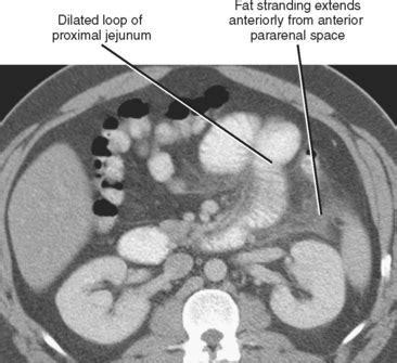 Sentinel Loop Sign In Pancreatitis - A sentinel loop is a sign seen on ...