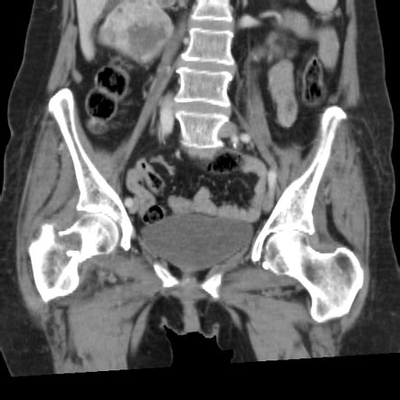 Pathological right femur basicervical fracture | Radiology Case ...