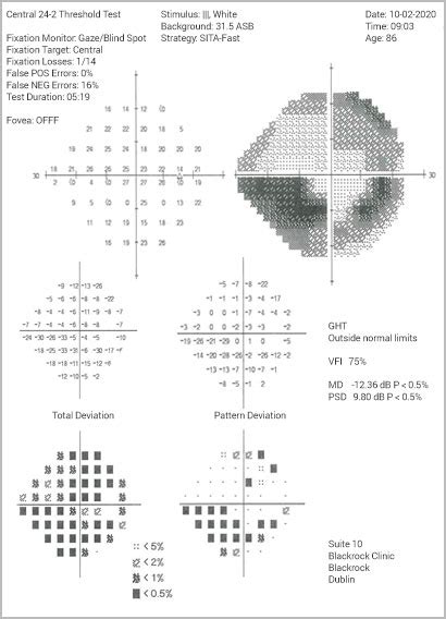 Visual Field Test – Visual Field Testing - Glaucoma Diagnosis